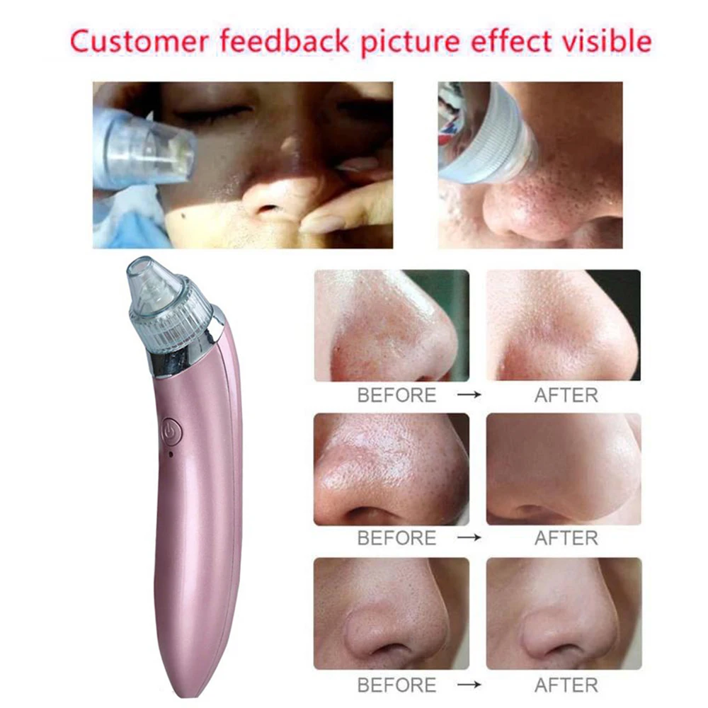 Blackhead Remover Face Deep Nose Cleaner T Zone Pore Acne Nose Skin Set Beauty Skin Care Tools