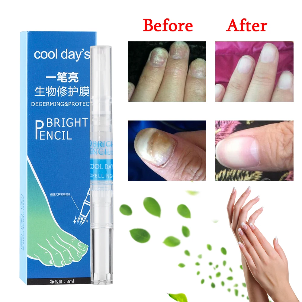 Effective Nail Treatment Pen Onychomycosis Paronychia Anti Fungal Nail