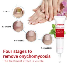 Лечение ногтей от грибка эссенция для ногтей и отбеливающий гель для ног для кутикулы ног ногтей Fungu Удаление Уход за ногами и ногтями гель с ножом Rasps