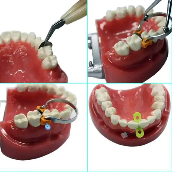 Aprovou o Jogo Dental das Matrizes Dental da Faixa da Matriz Secional Contornado Jogo ce - Fda 2 dental das matrizes jogo dental da faixa da matriz