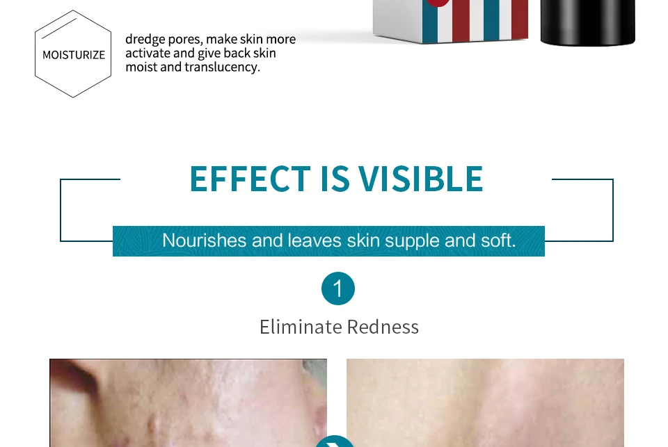 HEMEIEL крем от акне удаление шрамов анти-акне уменьшить покраснение ремонт уход за кожей корейский Осветление кожи лица увлажняющий крем 30 мл