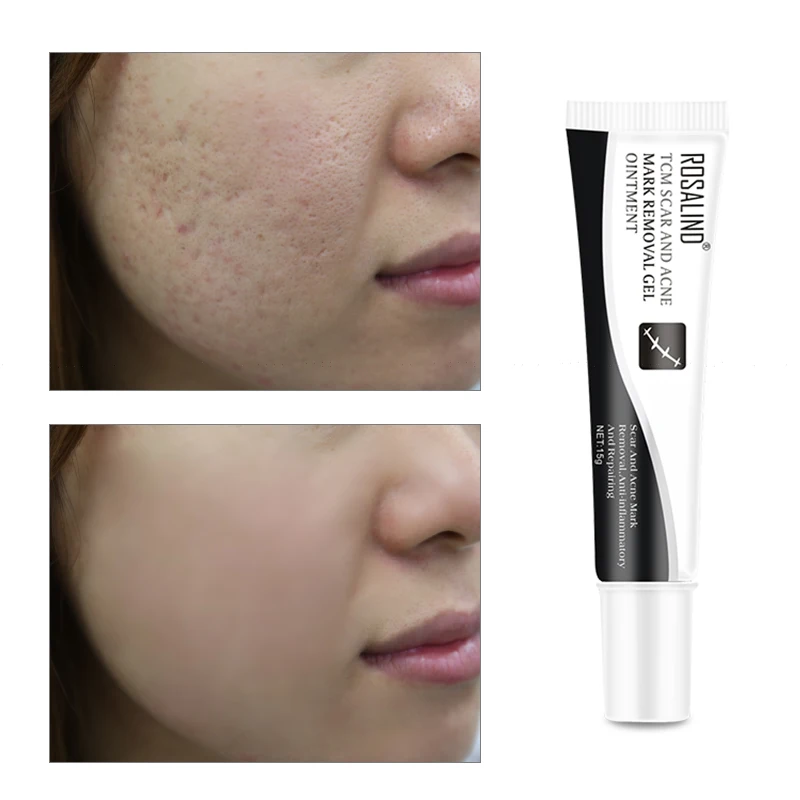 

ROSALIND Acne Scar Treatment Stretch Marks Remover Cream Acne Spots Repairing Skin Serum Blackhead Oil Control Whitening Cream