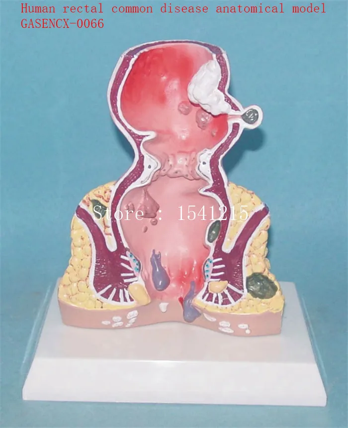 

Human anatomy model Simulation man model Medical model Human rectal common disease anatomical model - GASENCX-0066