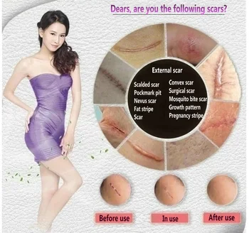 

face anti care acne treatment cream scar removal oily skin Acne Spots skin care face stretch marks remover