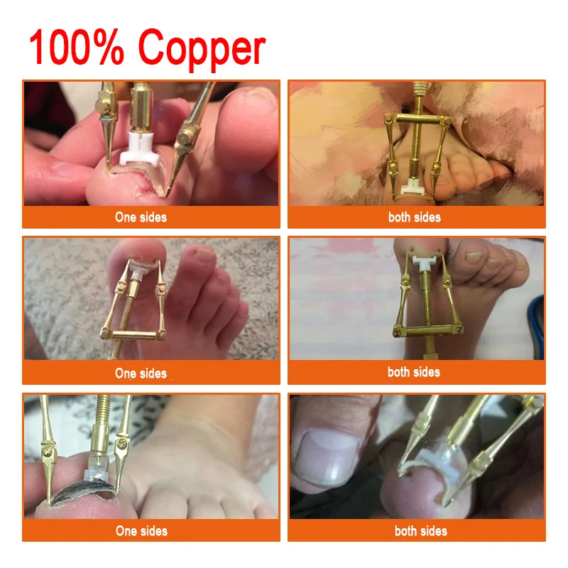 Медь 2 в 1 инструмент для коррекции вросших пальцев ног для 1 или 2 сторон для вросших ногтей, педикюра