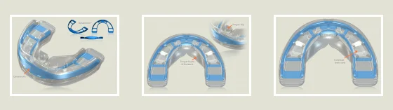 Mrc trainer t3 uso dentição permanente dentes ortodôntico trainer t1 t2 t3