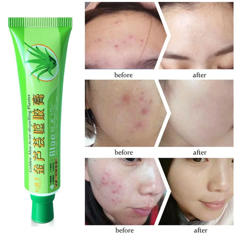 Gold Aloe Acne Dispelling Ointment Plaster Removal Cream Face Skin Care