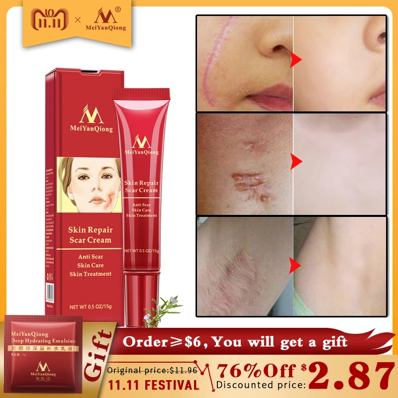 Buy Acne Scar Removal Cream Skin Repair Face Cream