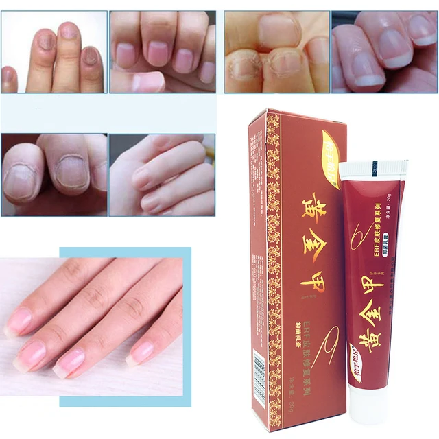 Chinese Medicine Herbs Toe Nail Fungus Treatment Anti Fungal Nail