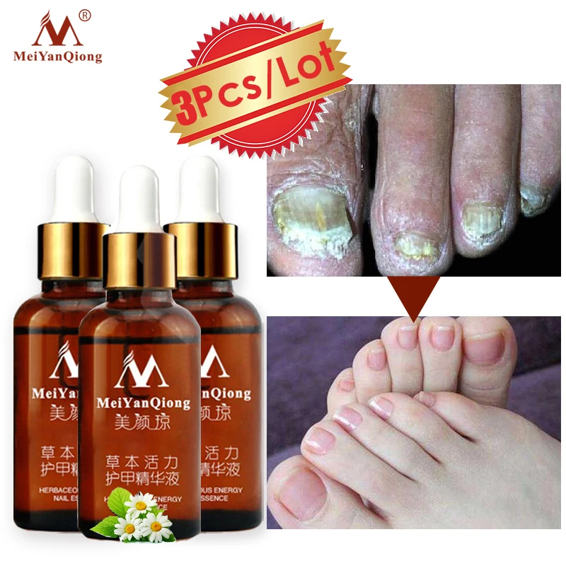 

3pcs/lot Fungal Nail Treatment Repair Essence Nail and Foot Hand Care Whitening Toe Nail Anti Fungus Removal Infection Nail Gel