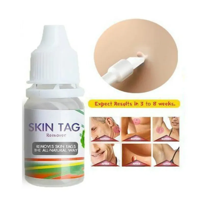 

Skin Tag Remover 12 hours Tu kill Medical Tu kill Remover Skin Tag Mole & Genital Wart Remover Foot Corn Removal 10ml