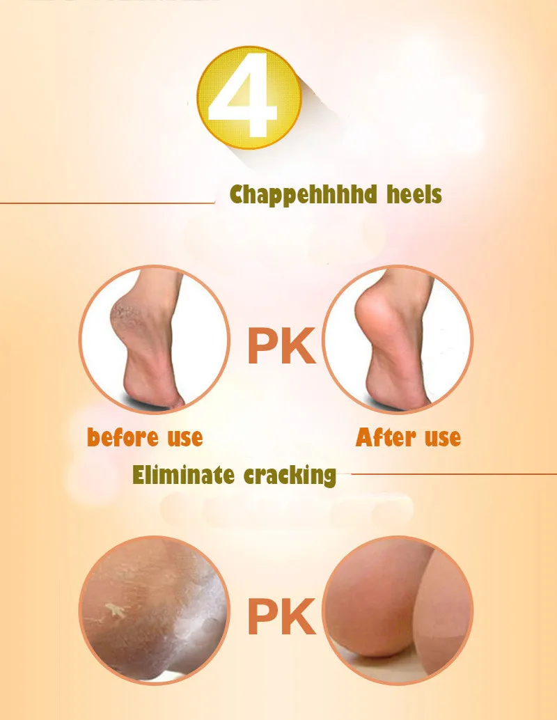 Cracked-heel-foot-careSEBS-0012