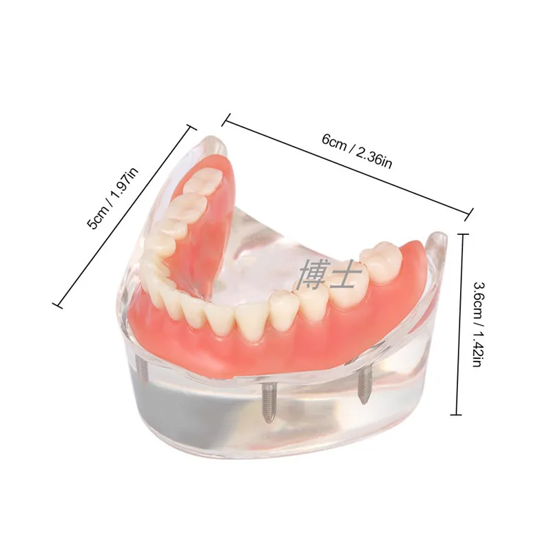 Модель зубных имплантатов, съемные внутренние нижние челюсти, модель зубов с 4 винтами, обучающая модель для ремонта
