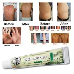 Zudaifu кожи крем от псориаза дерматит Eczematoid Eczema мазь лечение крем от псориаза уход за кожей крем дропшиппинг