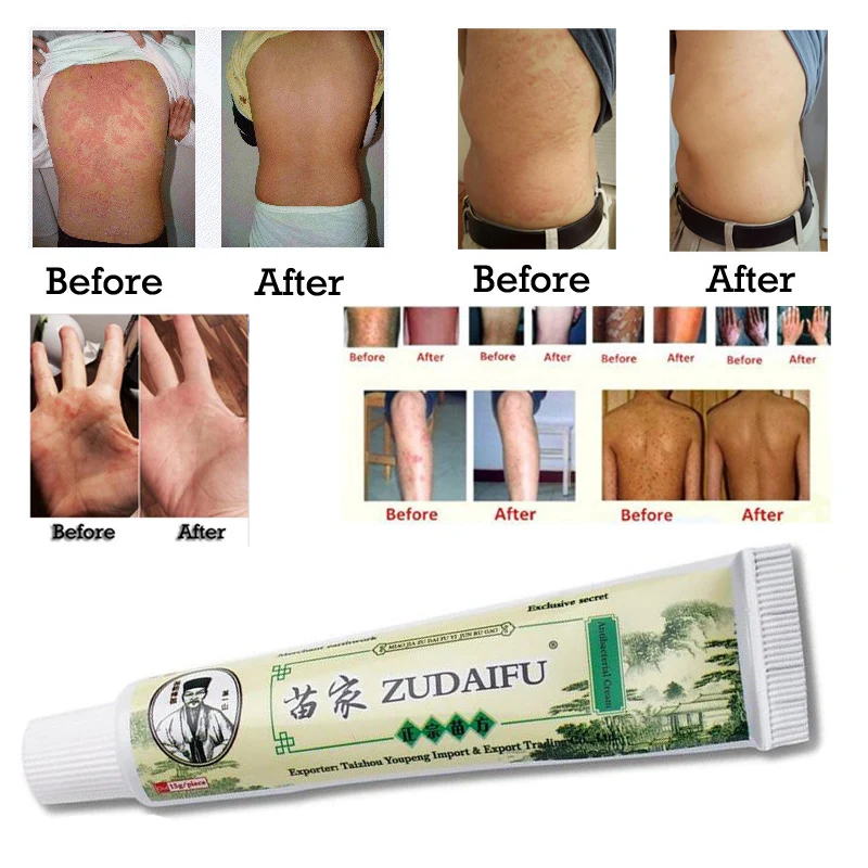 Zudaifu Skin Psoriasis Cream Dermatitis Eczematoid Eczema Ointment