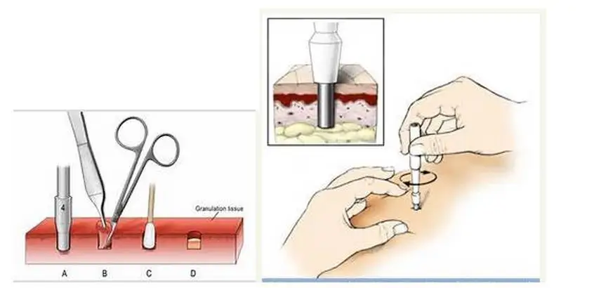 Inoxidável Esterilizado Biópsia Perfurador Cutâneo Socos Corpo Pele Piercing Ferramenta Aço 4 Aplicador de sombra