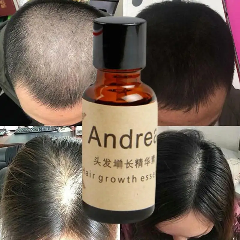 Andrea Hair Growth Serum Oil Herbal Keratin Fast Hair Growth Alopecia Loss Liquid Ginger Sunburst Yuda Pilatory Oil Andrea Hair Growth Serum Oil Herbal Keratin Fast Hair Growth Alopecia Loss Liquid Ginger Sunburst Yuda Pilatory Oil