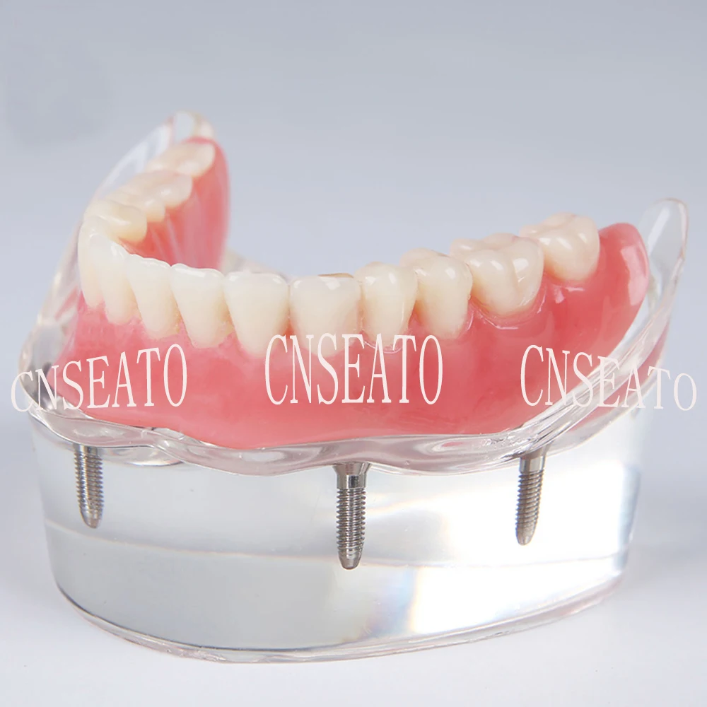 

1 pc Dental Implant Restore Demonstration Teeth Model M-6003 Denture care and Teeth whitting