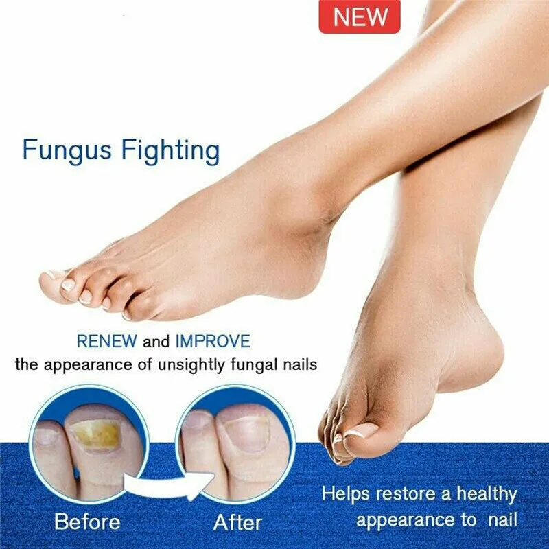 

The Nail RepairLiquid Treatment Pen Onychomycosis Paronychia Anti Nail Infection