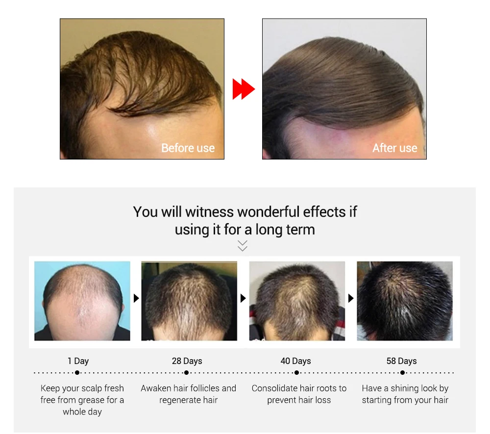 2 шт Okeny's 20 мл эссенция для роста волос Быстрый мощный Уход за волосами Эфирное Масло жидкое лечение Предотвращение выпадения волос продукты