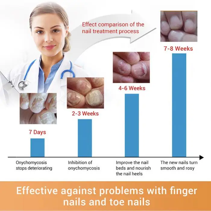 12 мл Лечение грибка для ногтей с пилкой противогрибковый онихомикоз Удаление Уход за ногтями восстанавливающая жидкость