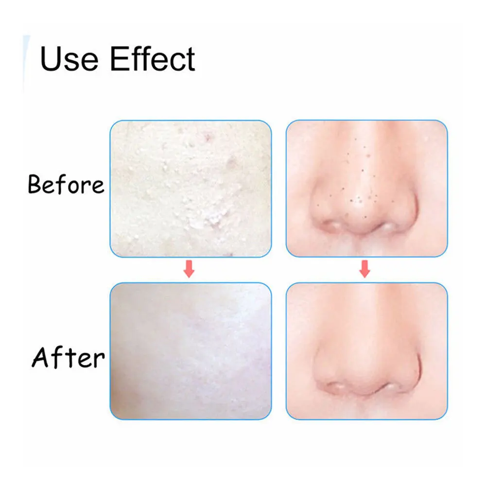8 шт Blackhead угри, прыщи инструмент для удаления прыщей, инструмент для удаления комплект изогнутые пинцеты