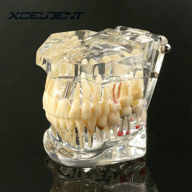 1 шт. зубной имплантат, зубная модель с реставрационным мостом, зубной Стоматолог для медицинской медицины, стоматологический тест на лечение