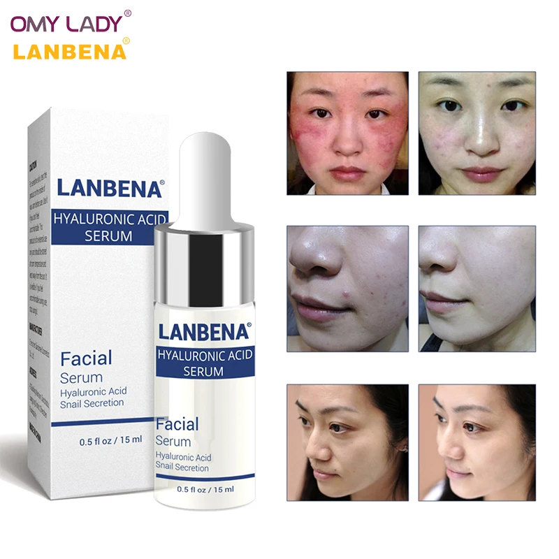 OMY LADY LANBENA Hyaluronic Acid Essence Snail Serum Face Cream Moisturizing Acne Treatment Skin Care Repair Whitening AntiAging OMY LADY LANBENA Hyaluronic Acid Essence Snail Serum Face Cream Moisturizing Acne Treatment Skin Care Repair Whitening AntiAging