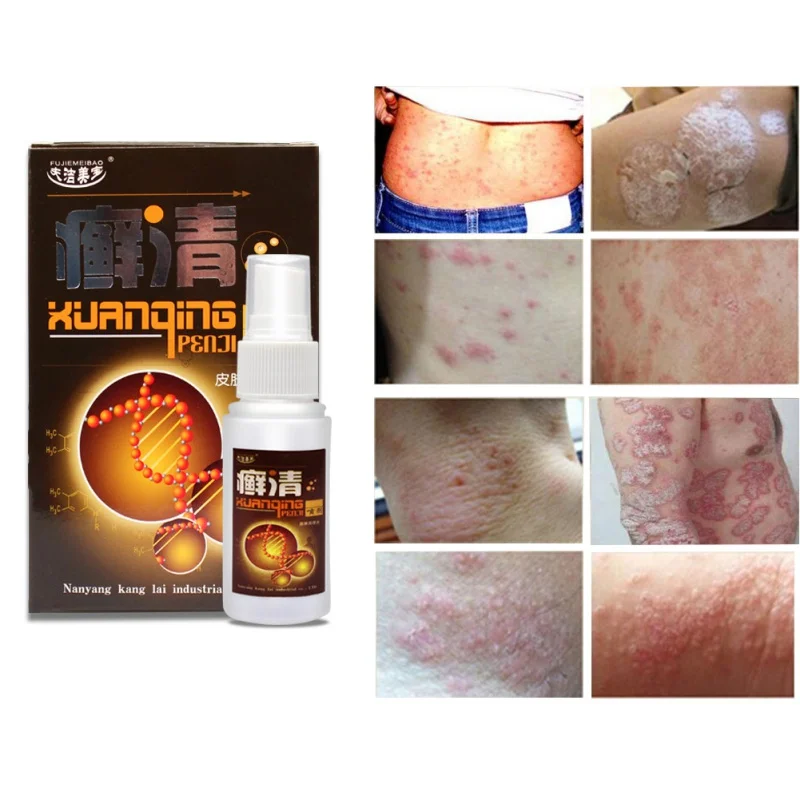 

Herbal Creams Psoriasis Treatment Spray Sterilization Relieve Itching Plant Herbal Extract Liquid