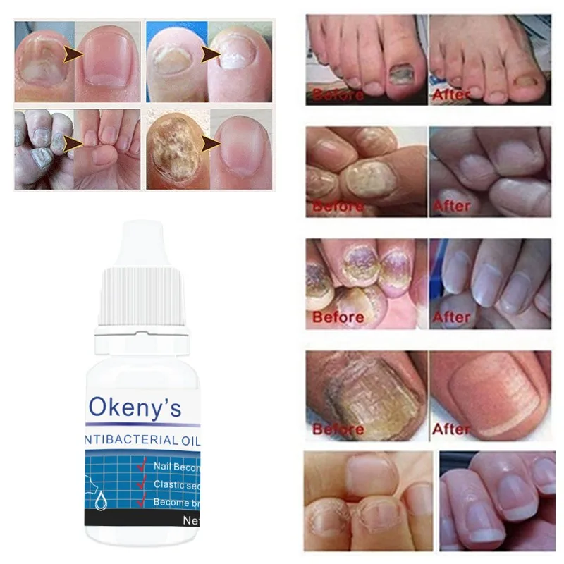 Ногти для ног "францзуский маникюр" и ногтей гриб онихомикоз удаления Антибактериальный масло Лечение грибка ногтей