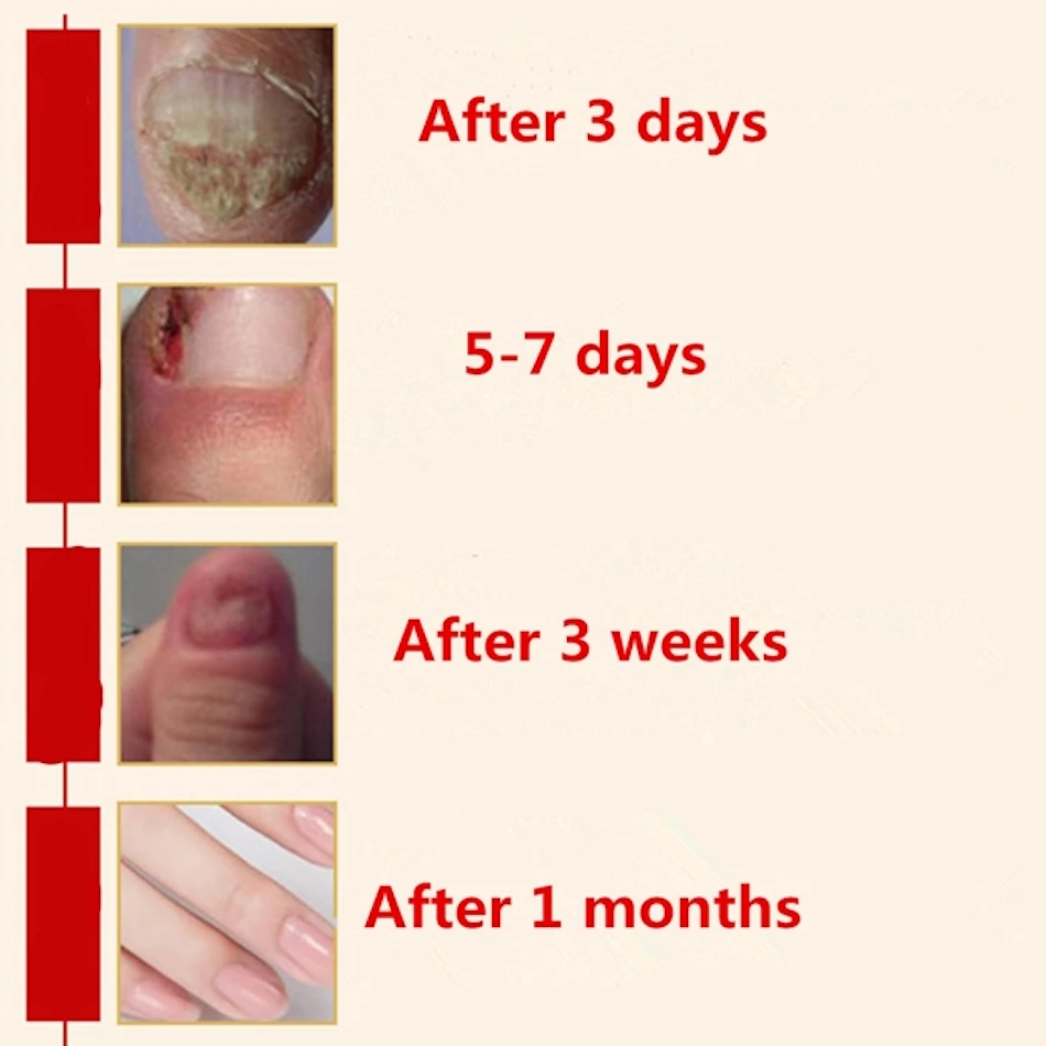 AFY Toenail Fungus Treatment Serum Foot Toe Nail Fungus Treatment Fungal Nail Cure Toenail Fungus Infection Onychomycosis Remove