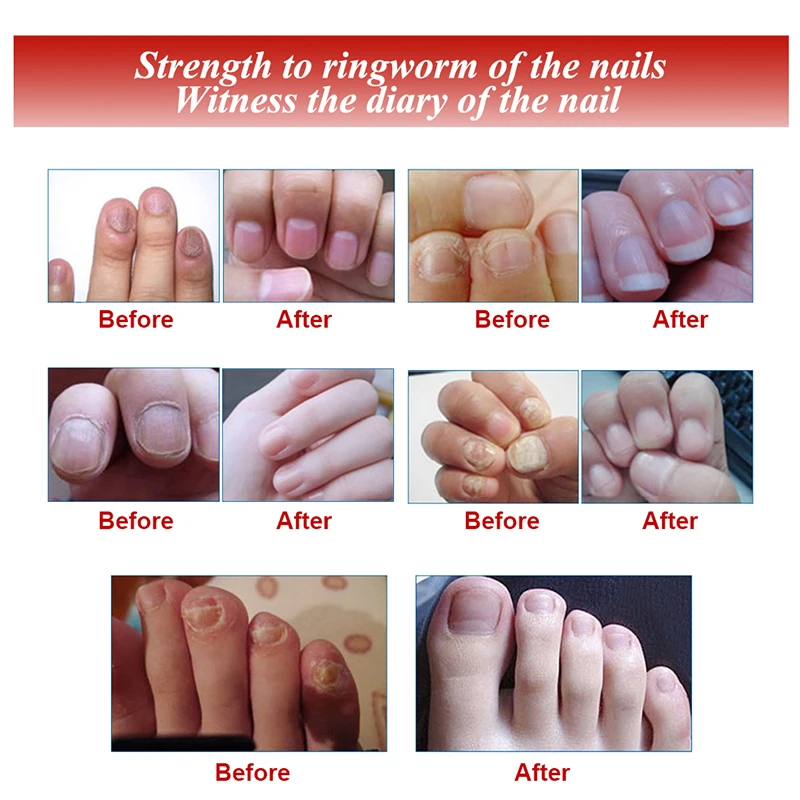 Полезно для ногтей Уход восстановление эссенция для ногтей и ног Уход за кожей рук отбеливание гвоздь с широкой шляпкой анти удаление грибка инфекции Гель-лак для ногтей