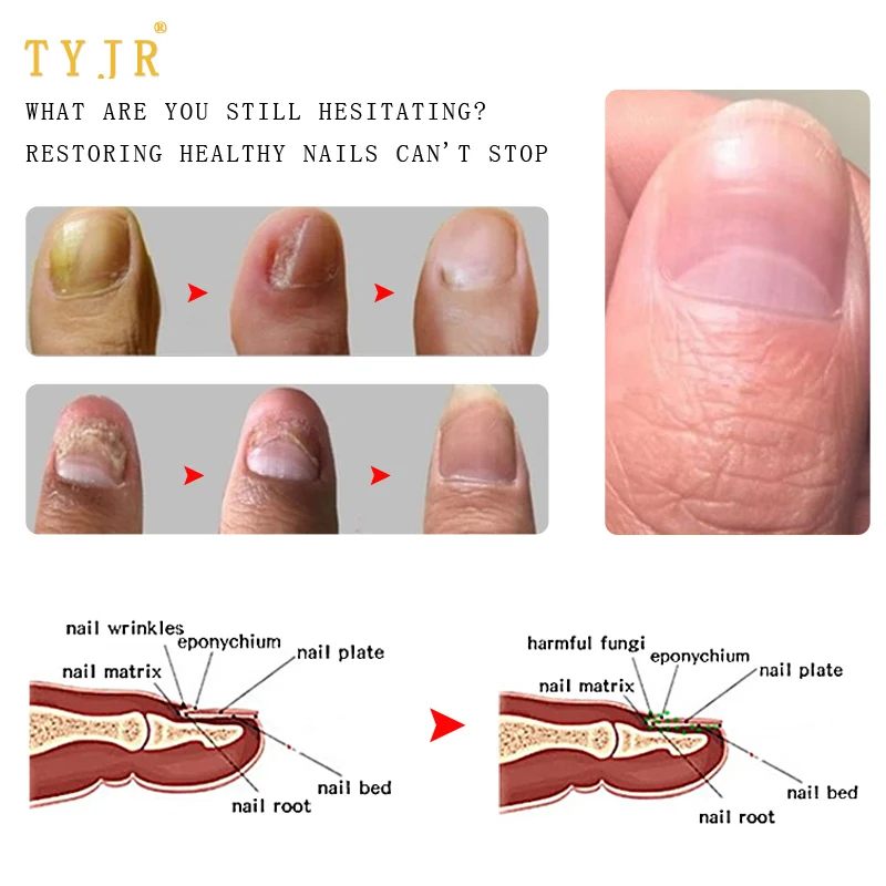 Paronychia: Causes and treatment of an infected nail