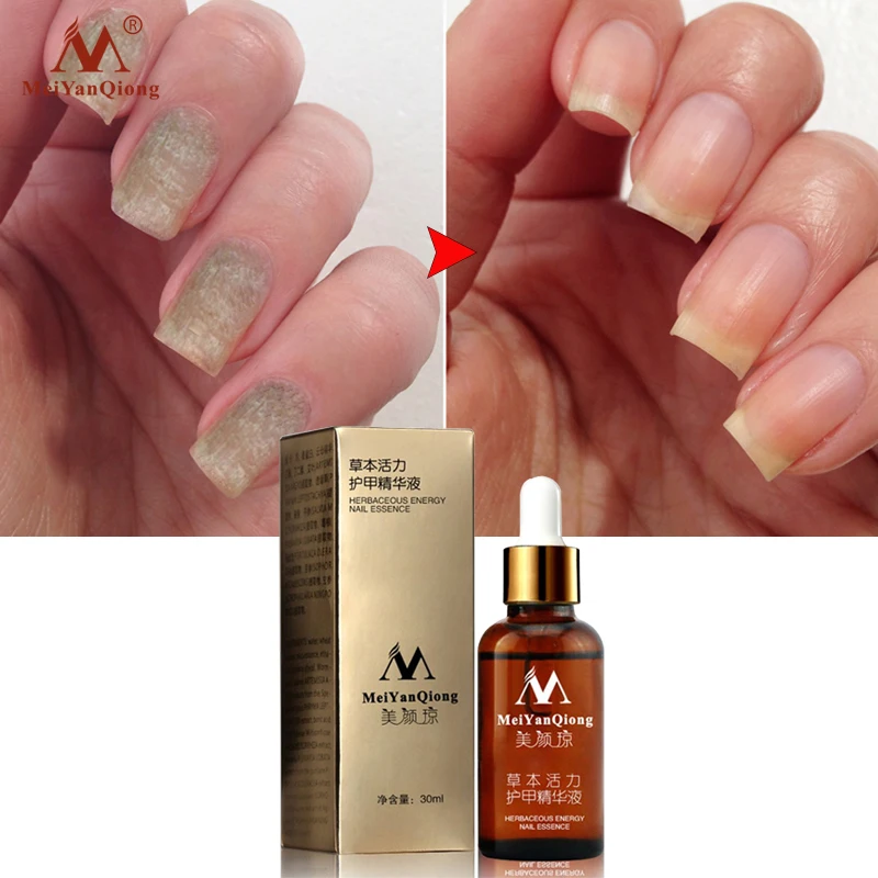 

Fungal Nail Treatment Essence Nail and Foot Whitening Toe Nail Fungus Removal Feet Care Nail Gel