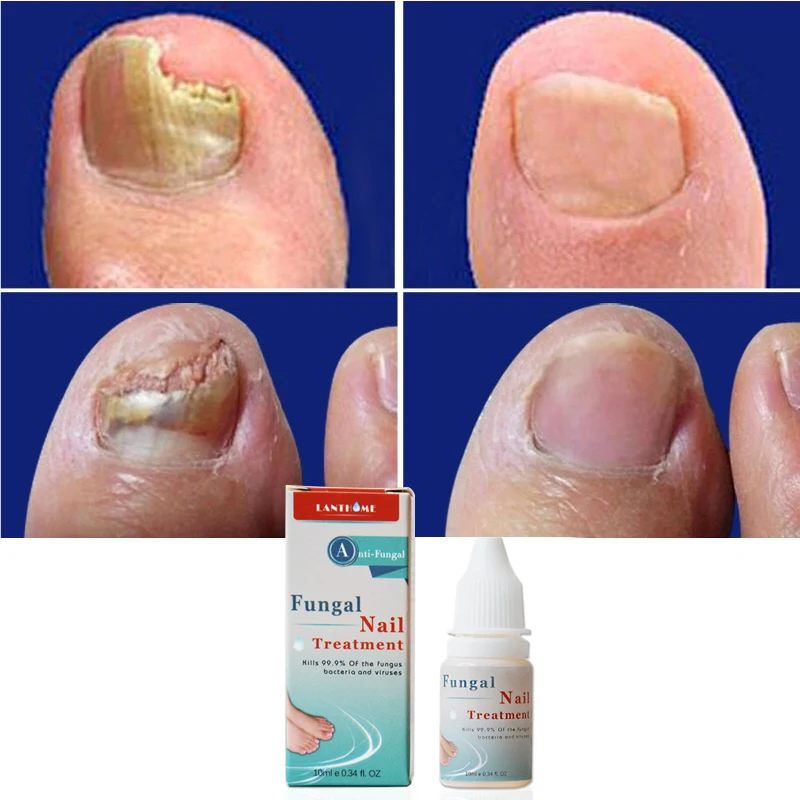 Lanthome Nail Repair Essence Fungal Nail Treatment Remove Onychomycosis