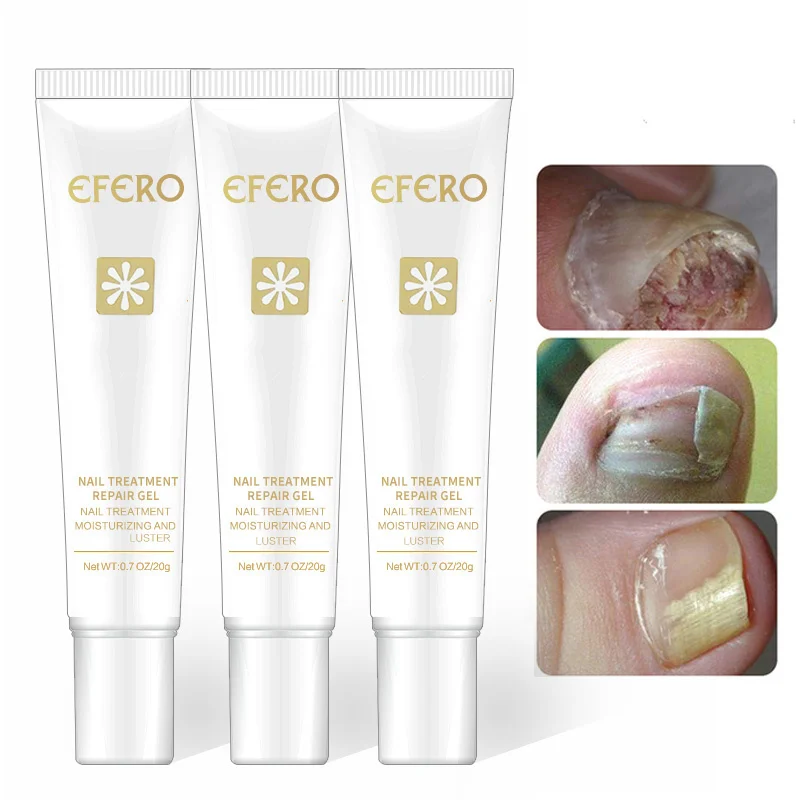 

Fungal Nail Treatment Feet Care Essence Toe Nail Fungus Removal Gel Anti Infection Onychomycosis Nails Repair Essence TSLM1