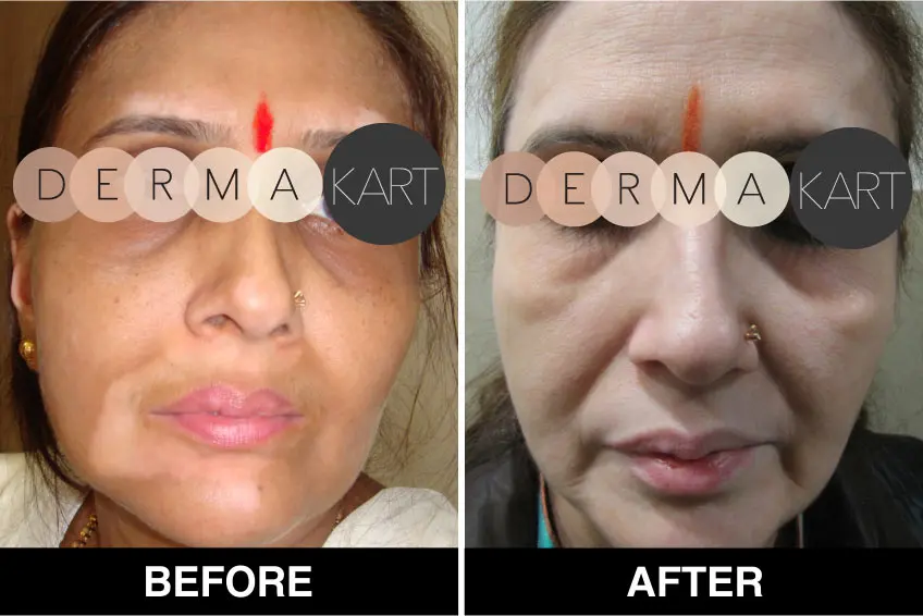 Günstig MONOBENZONE 20% WEIß GESICHT BLEACHING CREME VERBLASST HAUT TON LÖSCHT FLECKEN   ALTER FLECKEN