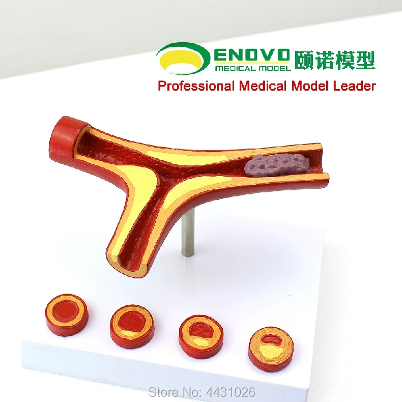 ENOVO Coronary arterial arteriosclerosis model elderly heart model thrombus cardiology