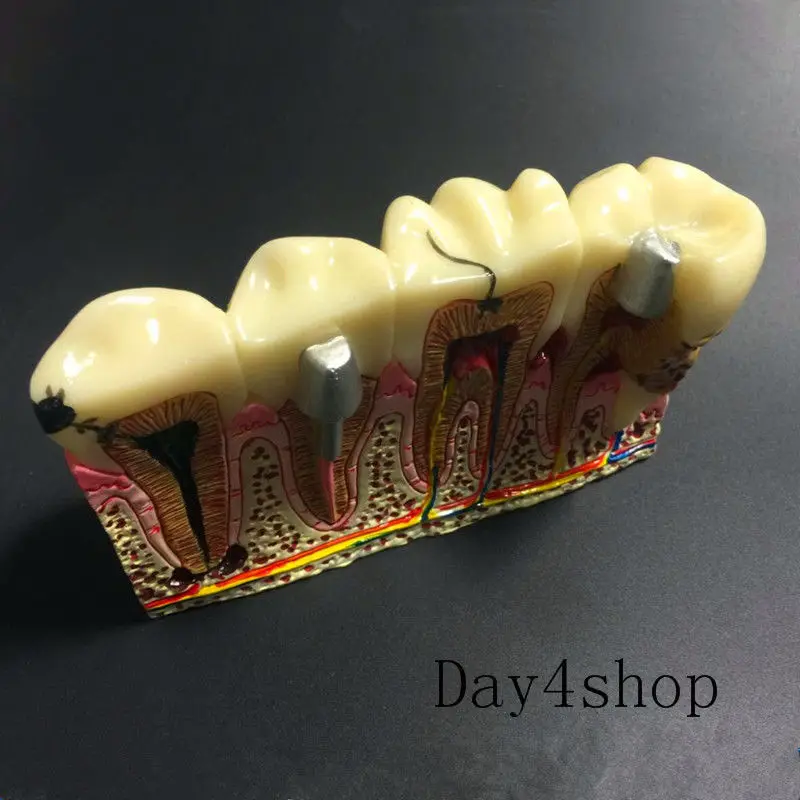 Стоматологическая Анатомия кариеса Зубы Пластмассовые модели демонстрация связи