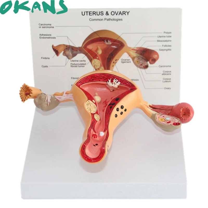

Pathological Uterus and Ovary Anatomical Model Human Female Medical Anatomy
