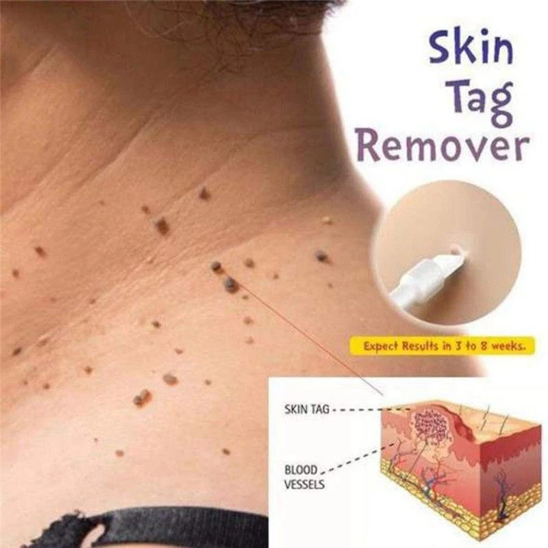 6ml Skin Tag Remover 12 Hours Remover Skin Smooth Care Tag Mole & Genital Wart Remover
