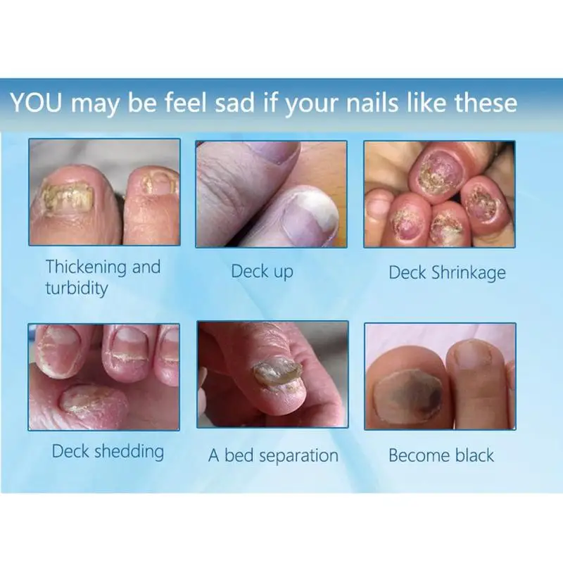 5ml Removal Onychomycosis Toe Nail Fungus Repair Anti Fungal Nail Treatment Liquid Remove Gel Antifungal Onychomycosis Cream Nail Treatments Aliexpress