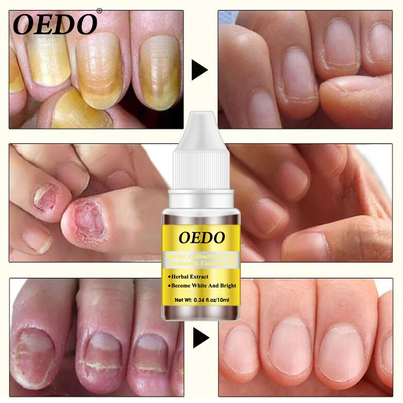 Herbal Antibacterial Nail Treatments Essential Oil Herbal Extract Nail Fungus Art Repair Tools Foot Nail Care Improve Infection