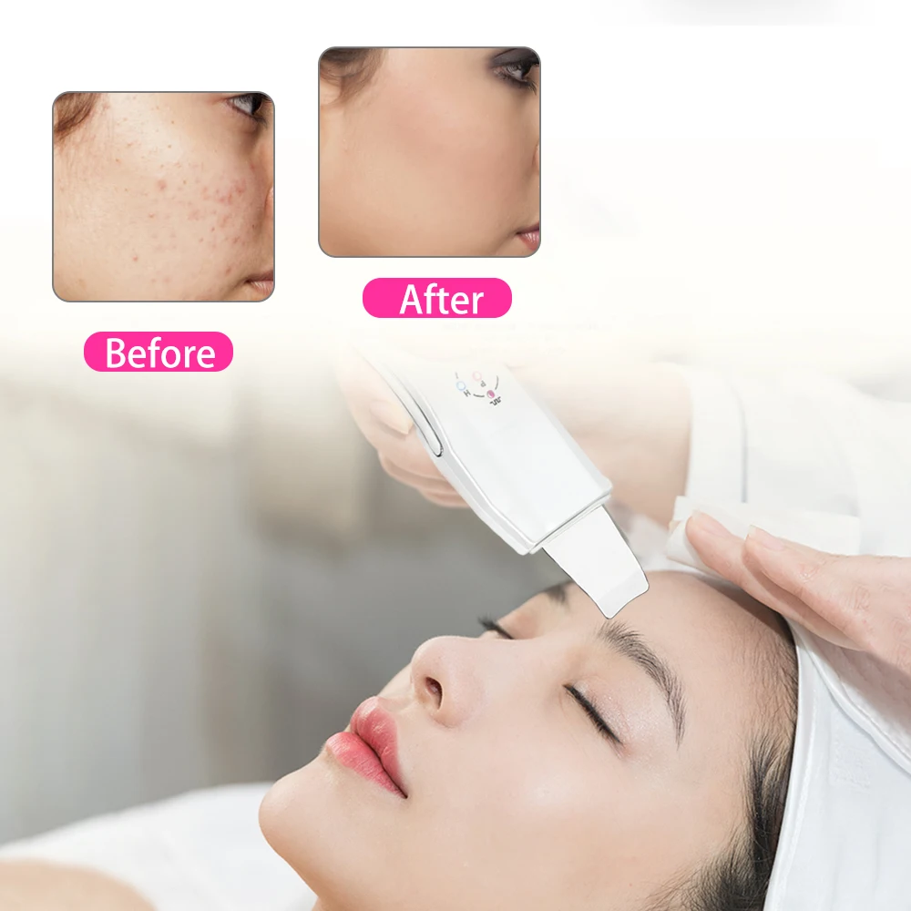 Skup Beauty Star ultradźwiękowy Peeling do skóry urządzenie do masażu kąpiel twarzy Anion do pielęgnacji skóry twarzy Peeling ultradźwiękowy Peeling do skóry