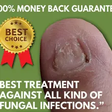 Лучшее лечение грибка для ногтей- гарантия возврата денег