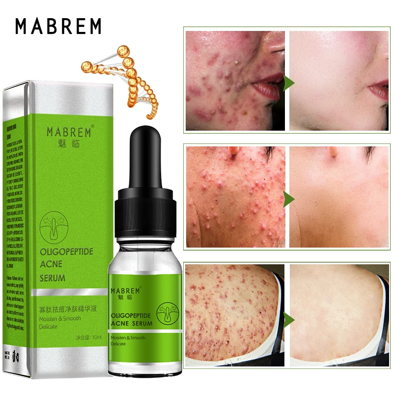 

10ml Face Brightening Serum Acne Scar Spots Serum Shrink Pores Eliminates Oil control Oligopeptide Acne Cleaning Lotion Serum