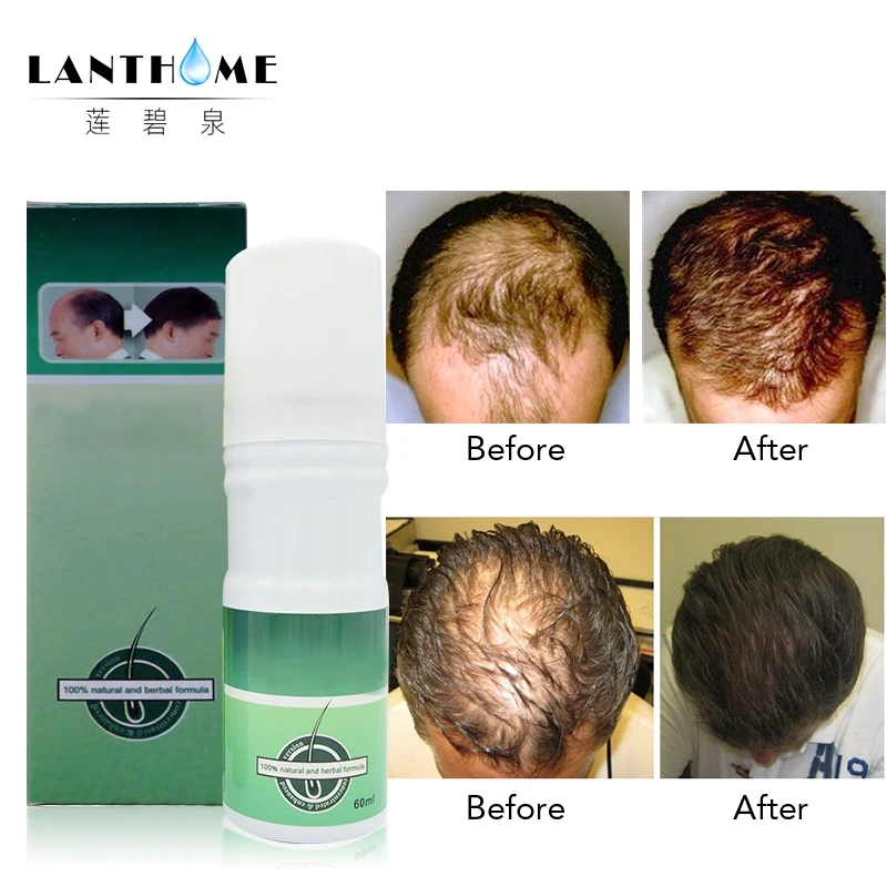 Lanthome Sunburst спрей для роста волос против выпадения волос алопеция лечение против облысения быстрое восстановление волос масла ЭКСТРА СИЛА