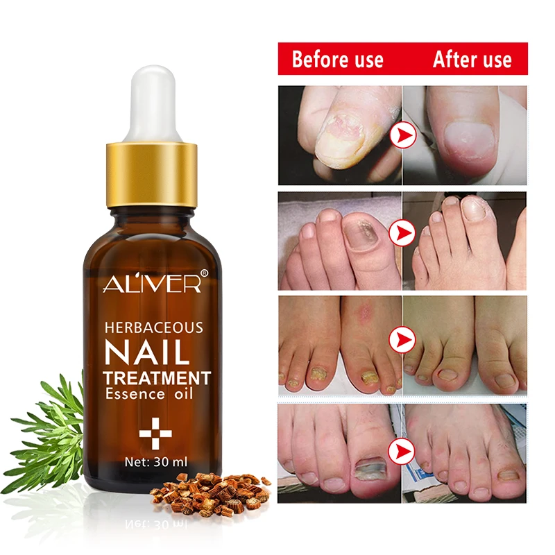 

Nail Repair Care Solution Remove Nail Fungus Care Essential Oil Nail Product Repair Nail Softening Repair Treatment TSLM1