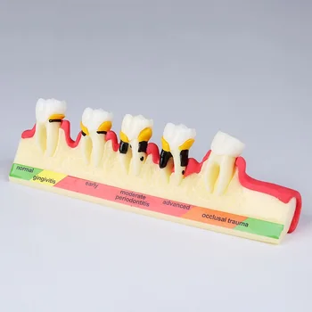 

Dental Learning teeth model Demonstrates the progress of Periodontal disease/dental pathological teeth model
