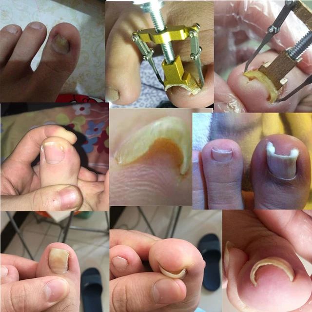 Paronychia Treatment 1pc Ingrown Toe Correction Nail Recover Clipper